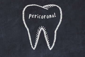 Wall Mural - Chalk drawing of a tooth with medical term pericoronal. Concept of learning stomatology