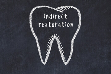 Wall Mural - Chalk drawing of a tooth with medical term indirect restoration. Concept of learning stomatology