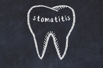 Wall Mural - Chalk drawing of a tooth with medical term stomatitis. Concept of learning stomatology