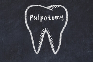 Wall Mural - Chalk drawing of a tooth with medical term pulpotomy. Concept of learning stomatology