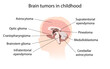 © maniki - Brain cancer, tumor with explanations. Sihuette of kid child head, inner view.