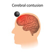 TBI. Cerebral contusion. Man, human head damage.