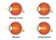 Vision disorders. Concept of eyes defect. Normal vision, hyperopia, myopia, astigmatism. Anatomy eyeball. Vector