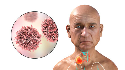 Poster - Thyroid cancer, tumor inside thyroid gland