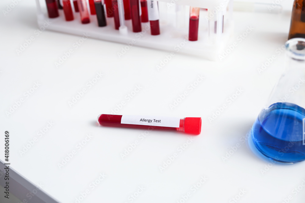 Allergy test on table in laboratory