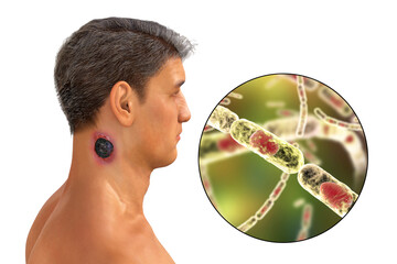 Sticker - Cutaneous anthrax, the most common form of anthrax