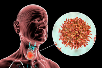 Sticker - Thyroid cancer, tumor inside thyroid gland