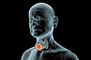 Poster - Thyroid cancer, illustration