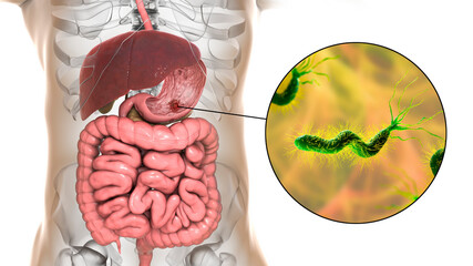 Poster - Peptic ulcer, stomach ulcer