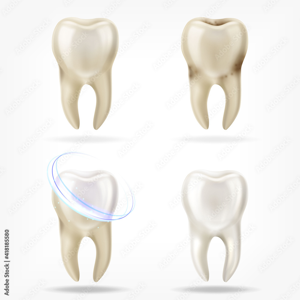 Vector set of 3d realistic clean and dirty tooth , clearing tooth ...