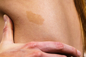 Closeup of brown birthmark on skin