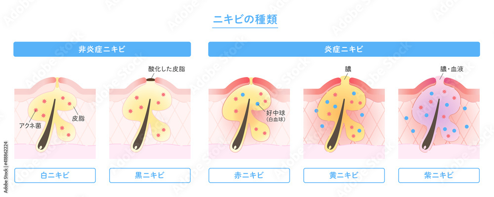 肌断面図で見せるニキビの種類のイラスト Acne Wall Mural Ac Dayano