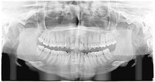 Panoramic X-ray Of Teeth. With Wisdom Teeth. Malocclusion. 