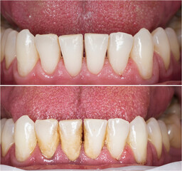 before and after picture for teeth cleaning