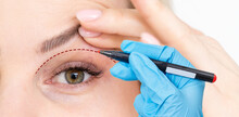 Woman Shows Drooping Eyelid For Plastic Surgery. Doctor Plastic Surgeon Marks With A Felt-tip Pen A Marker For A Surgical Operation