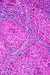 © Pansfun Images/Stocksy - ill human liver cells of biliary cirrhosis