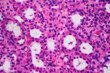 © Pansfun Images/Stocksy - kidney of patient with hypertension