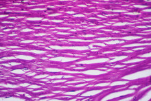 Micrograph Of Human Coronary Artery Atherosclerosis Cells