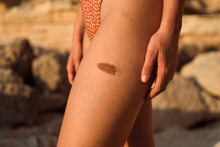 Birthmark On A Woman's Leg