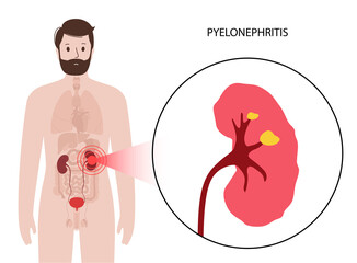 Sticker - Kidney disease concept