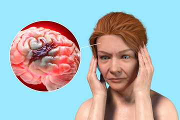 Sticker - Stroke, conceptual illustration showing woman with acute headache and rupture of brain blood vessel