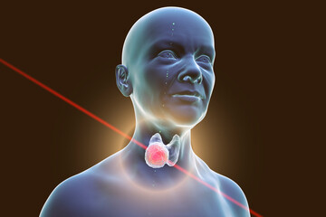 Poster - Thyroid cancer in women, illustration showing tumor inside thyroid gland