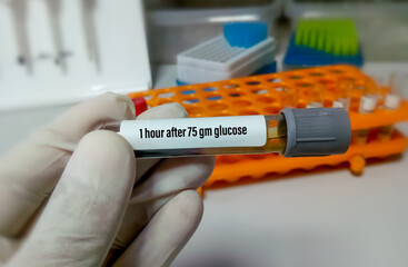 Poster - Scientist or Technician hold a sample tube for the test of Plasma glucose 1 hour after taking 75 gram glucose. Diagnosis of hyperglycemia or hypoglycemia. Glucose Tolerance test.