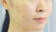 Damaged facial skin with heavy acnes and blemish