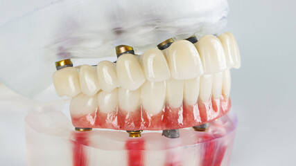 two dental prostheses for temporary wear in the bite on a white background