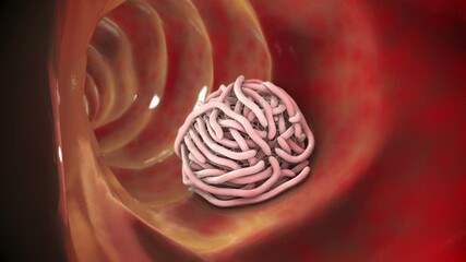 Sticker - Parasitic worms in the intestinal lumen, 3D animation. Growth and multiplication of nematode worms invading human intestine