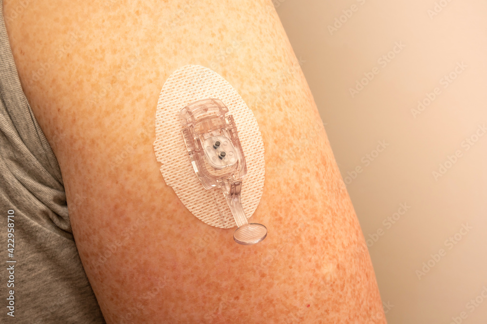 CGM - Continuous glucose monitoring: sensor installation on the upper ...