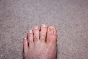 Aftermath of surgey to repair an ingrown toenail