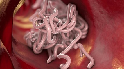 Sticker - Parasitic worms in the lumen of the lumen, 3D animation. Growth and multiplication of nematode worms invading human intestine