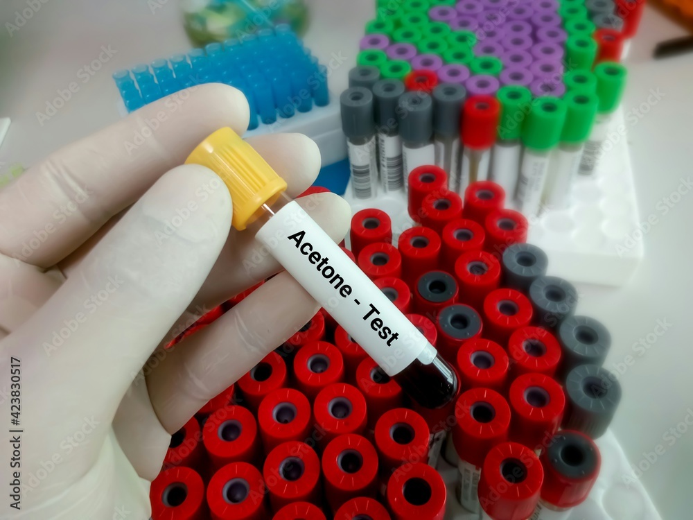 Blood sample for acetone test, diagnosis of life-threatening problems ...