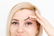 woman shows drooping eyelid for plastic surgery