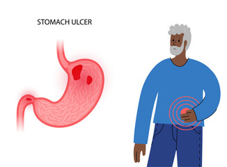 Wall Mural - Stomach ulcer concept