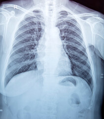 Naklejka na meble X-Ray Image Of Human Chest for a medical diagnosis
