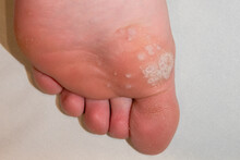 Sole Of Foot Showing Mosaic Plantar Wart And Other Verrucas Including The Black Spot Clotted Blood Vessel Centres