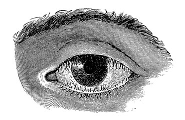 Eyelids with inwardly thinned eyelashes (Trichasis). Illustration of the 19th century. Germany. White background.