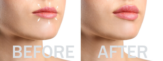 Canvas Print - Young woman before and after lips enhancement, closeup