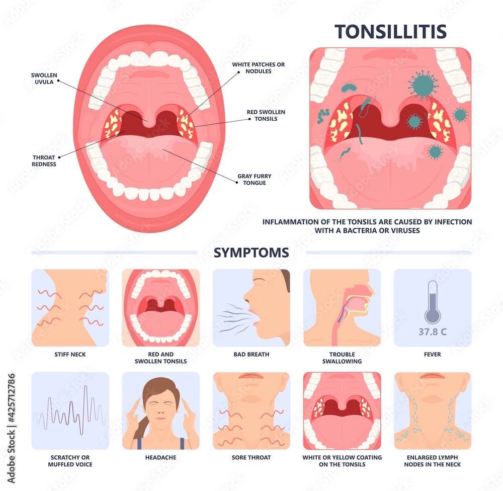 Tonsil Stones crypts viral virus gland strep throat sore enlarged lymph  nodes neck pain swollen pus, image size:1000x976