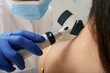 © Peakstock - Mole dermatoscopy. Doctor examines the patient's mole with a dermatoscope for prevention of melanoma, close-up.