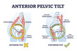 Anterior pelvic tilt model compared with posterior in labeled outline diagram