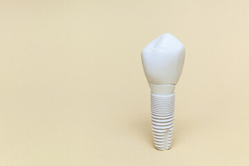 Dental implant. Dental implant model of artificial tooth