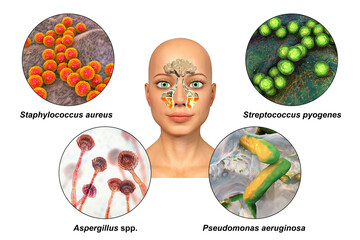 Canvas Print - Anatomy of rhinosinusitis and microorganisms that cause sinusitis