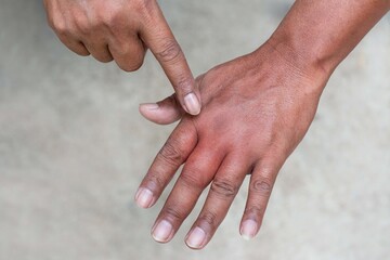 Swollen hand from insect sting, man pointed to the finger that was swollen due to insect bites, closeup of swollen hand with bug bite and red skin