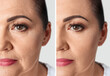 © New Africa - Collage with photos of mature woman before and after biorevitalization procedure, closeup