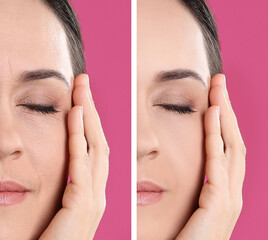 Canvas Print - Collage with photos of mature woman before and after biorevitalization procedure on pink background, closeup