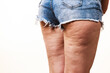 Woman legs with cellulite skin