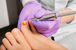 © Peakstock - Patient having laser treatment fungal infection on toenail, close-up. Onychomycosis treatment with a medical laser at a clinic